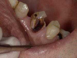 大きな虫歯の治療 市川市の歯医者 行徳スマイル歯科